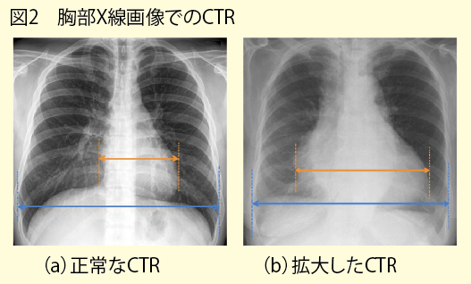 肥大 心臓