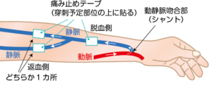 左手首～肘までの血管を表現したイラストです。手首部分の動脈と静脈が合流している部分に動静脈吻合部（シャント）があります。痛み止めテープは静脈上の穿刺予定部位の上、脱血側・返血側それぞれ一か所ずつに貼ります。血管は人によってさまざまですので、詳細は施設スタッフにご確認ください。