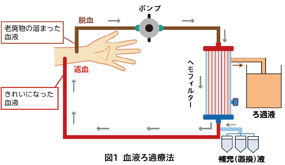 図1 血液ろ過療法 老廃物のたまった血液がポンプを通って脱血しへもフィルターを通って補充液を追加され、返血される図