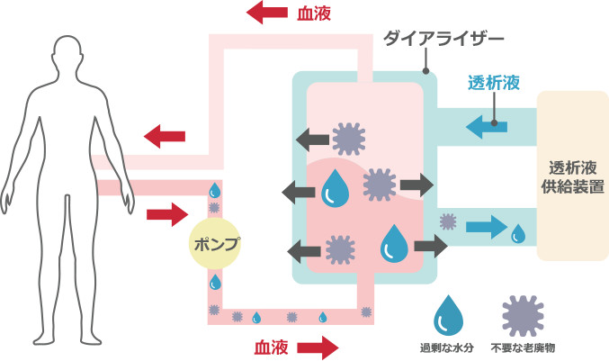 血液透析のしくみ