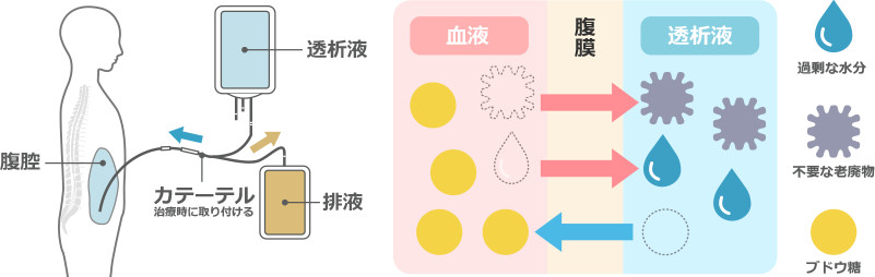 腹膜透析のしくみ