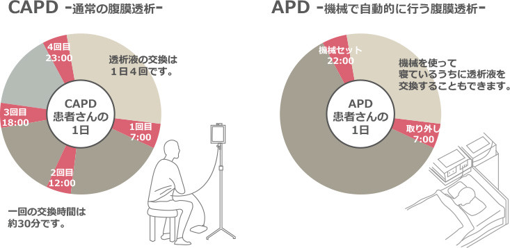 腹膜透析の種類