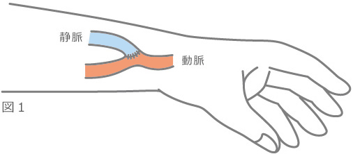 シャント（動静脈瘻）