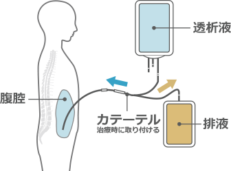 腹膜透析のしくみ